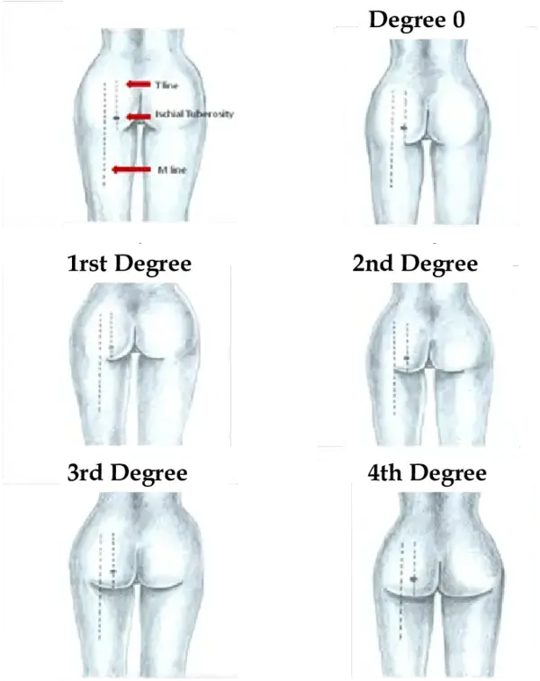 Is it an hourglass shape, or is it just gluteal ptosis?